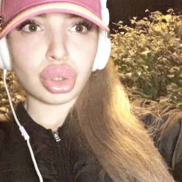 Дівчата, які переборщили з ботоксом і силіконом (25 фото) – фото 1