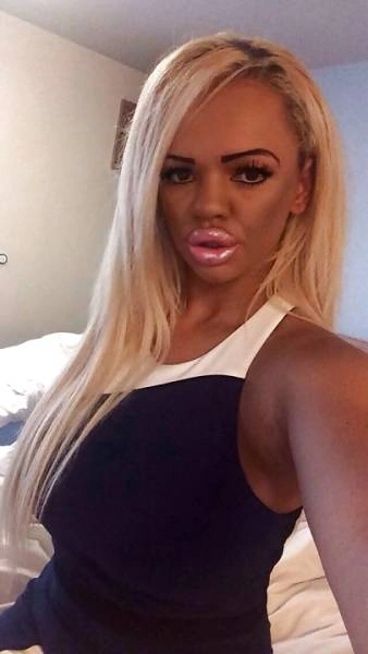 Дівчина переборщила з ботоксом і силіконом (21 фото) – фото 11